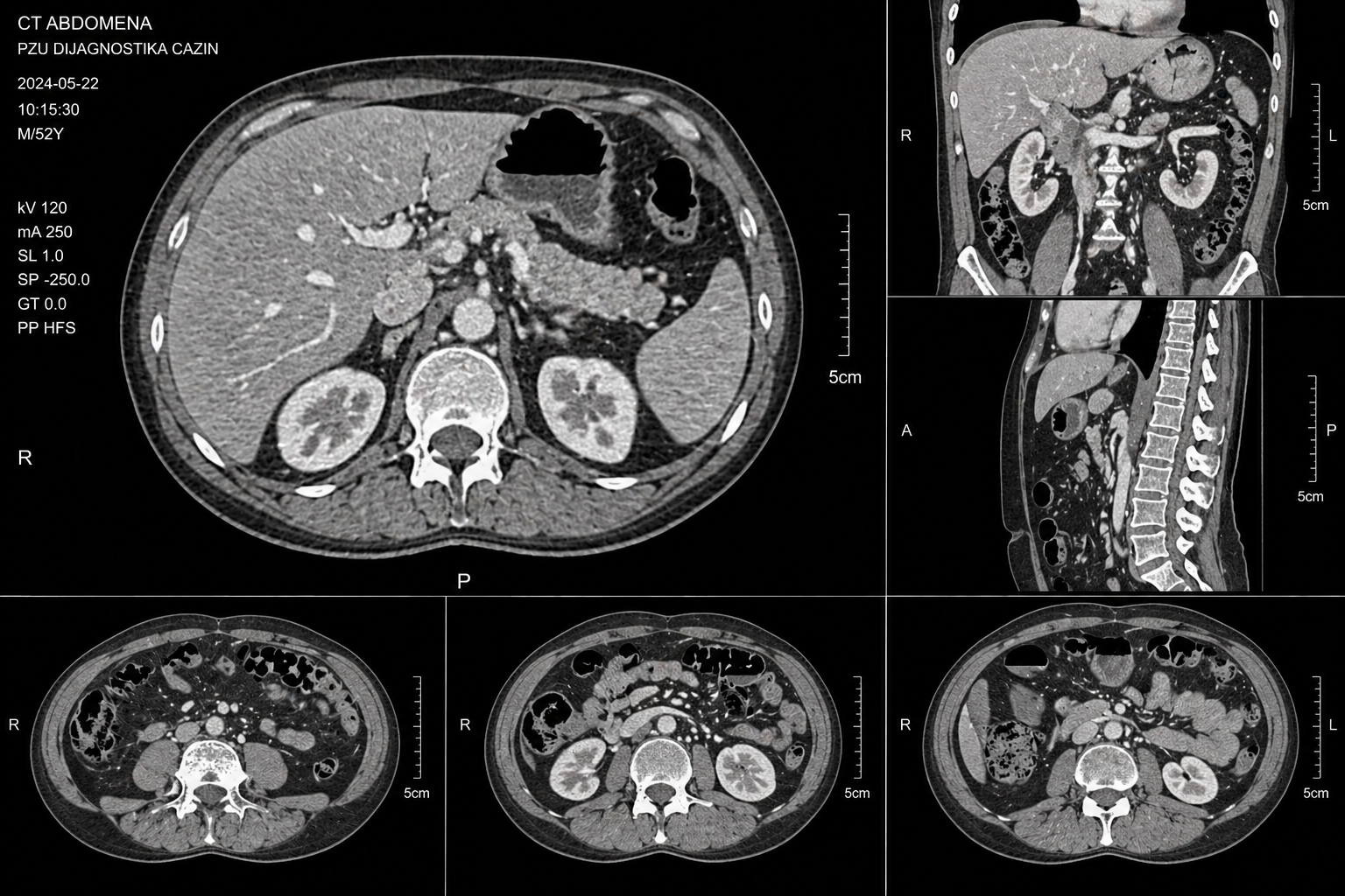 ct-abdomena