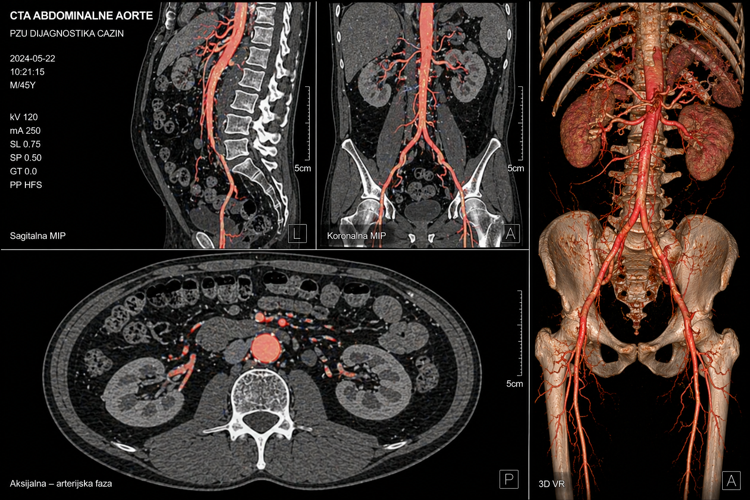 cta-abdominalne-aorte
